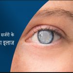 बिना ऑपरेशन मोतियाबिंद का इलाज - Cataract Treatment without Surgery in India