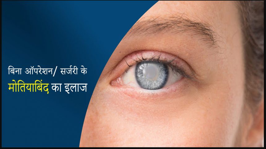 बिना ऑपरेशन मोतियाबिंद का इलाज - Cataract Treatment without Surgery in India