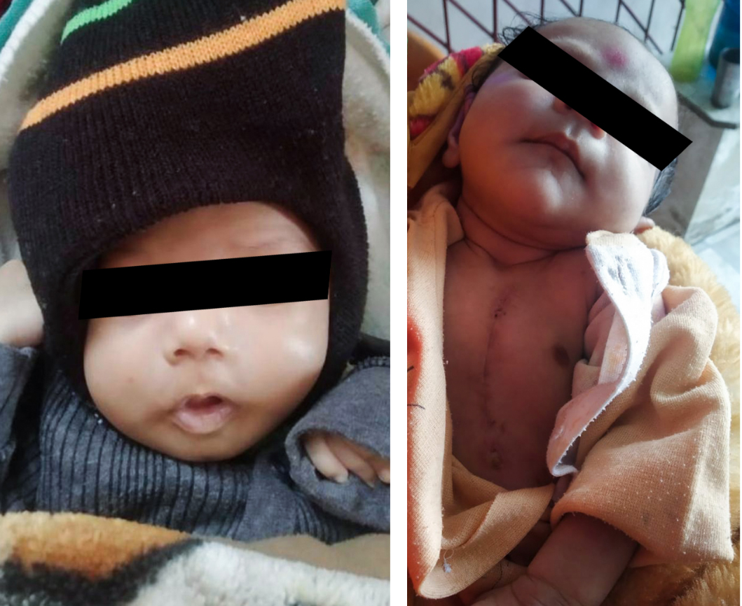 फरीदाबाद के अमृता अस्पताल में दुर्लभ दिल की बीमारी वाले दो नवजातों का आर्टेरियल स्विच ऑपरेशन हुआ