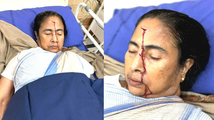 ममता बनर्जी के माथे-नाक पर 4 टांके लगे, डॉक्टर बोले- उन्हें किसी ने धक्का दिया था