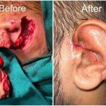 Pitbull bit the ear of a 22 year old youth, Amrita Hospital Faridabad treated him successfully after 11 hours of reconstructive surgery.